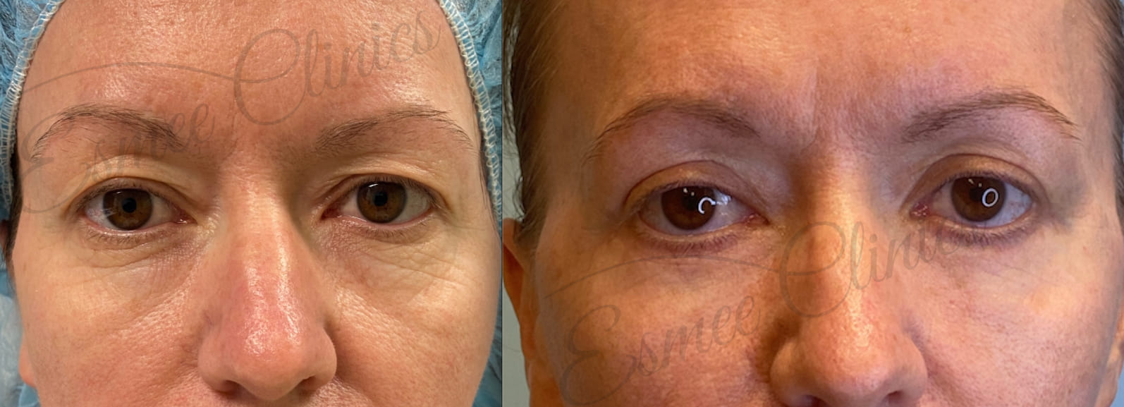 Before and After img